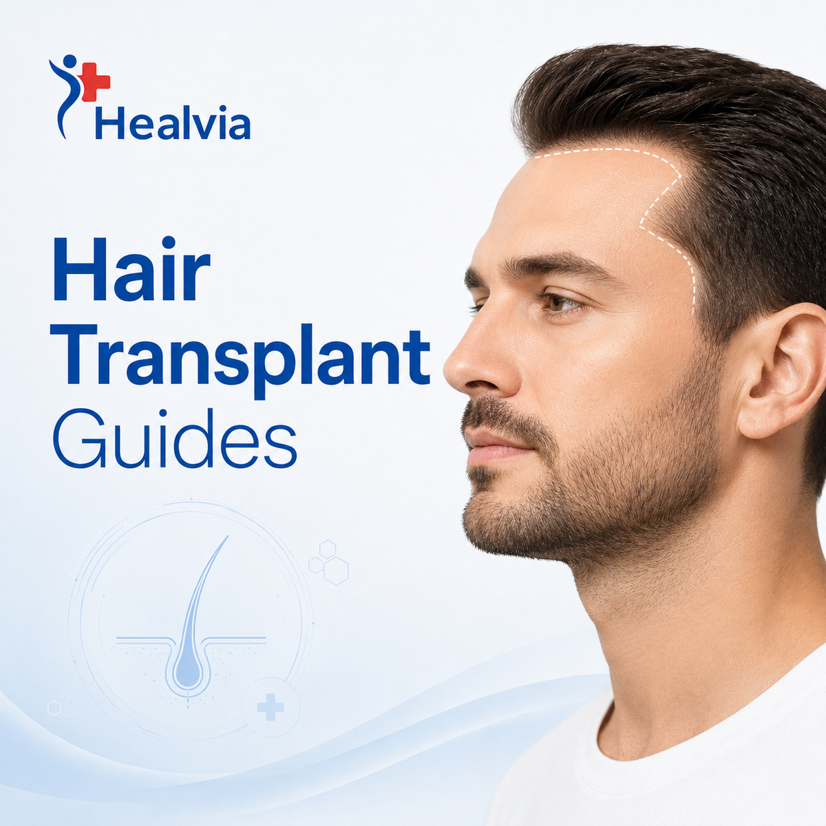 Hair Transplant Guides