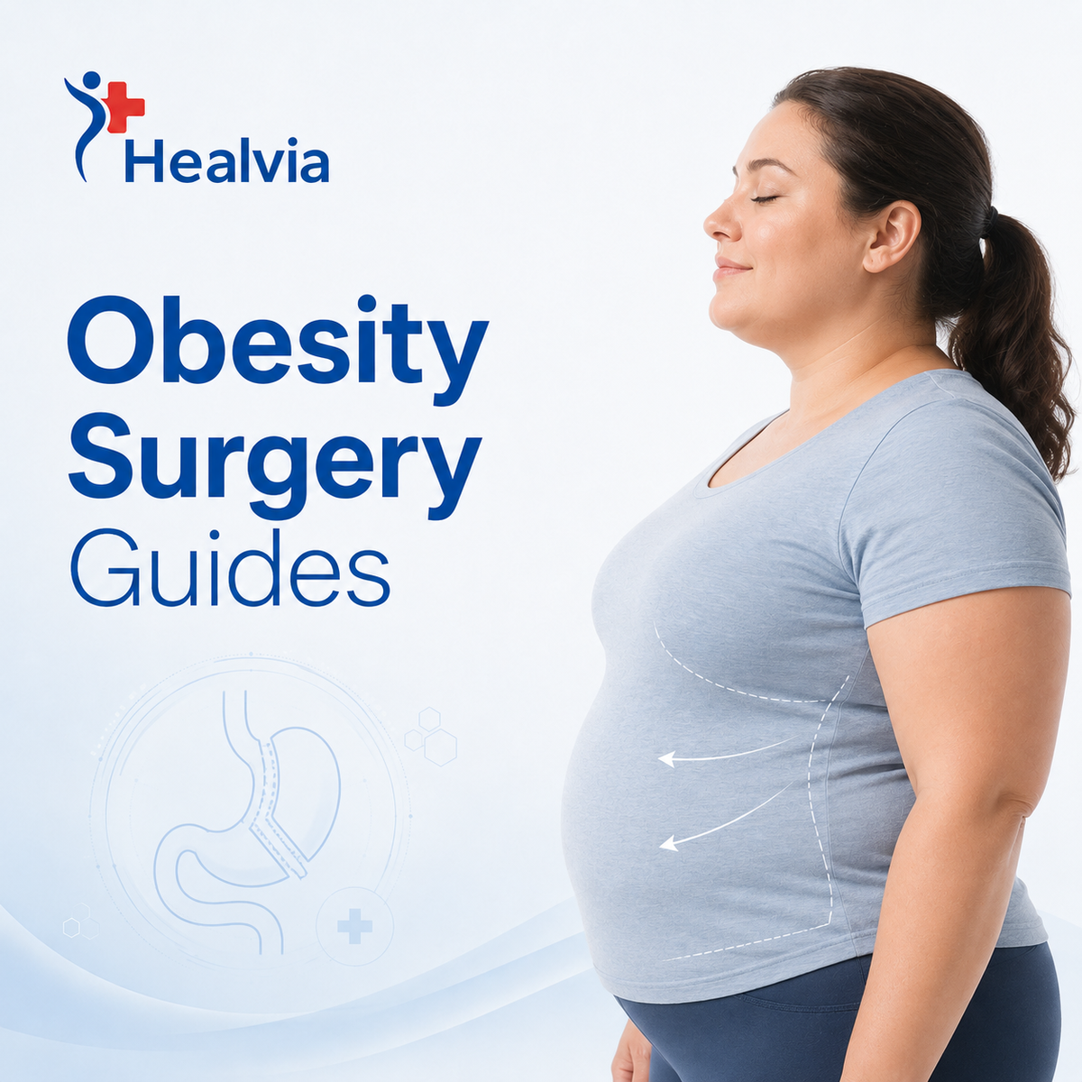 Obesity Surgery Guides