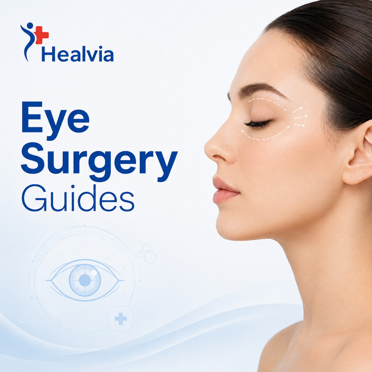 Eye Surgery Guides